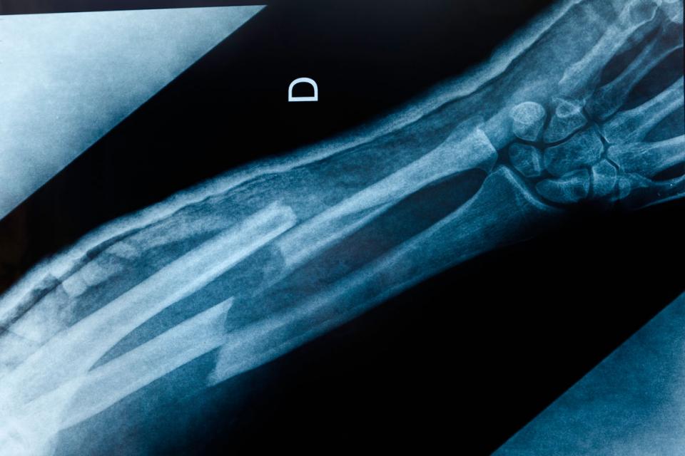 Radiographie d'un os cassé dans le bras