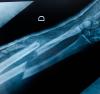 Xray image of a broken bone in arm